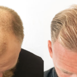 Så snabbt fick Daniel, 40 år, tillbaka sitt hår – med en hårtransplantation