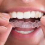Vill du justera tänderna med en tandställning som inte syns?