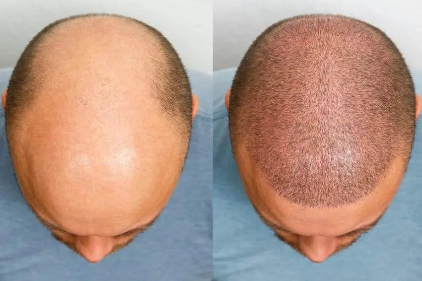 Därför är det bra att göra din hårtransplantation i Turkiet